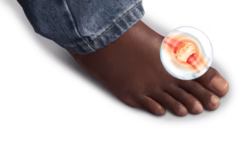 foot with tophi graphic on it.